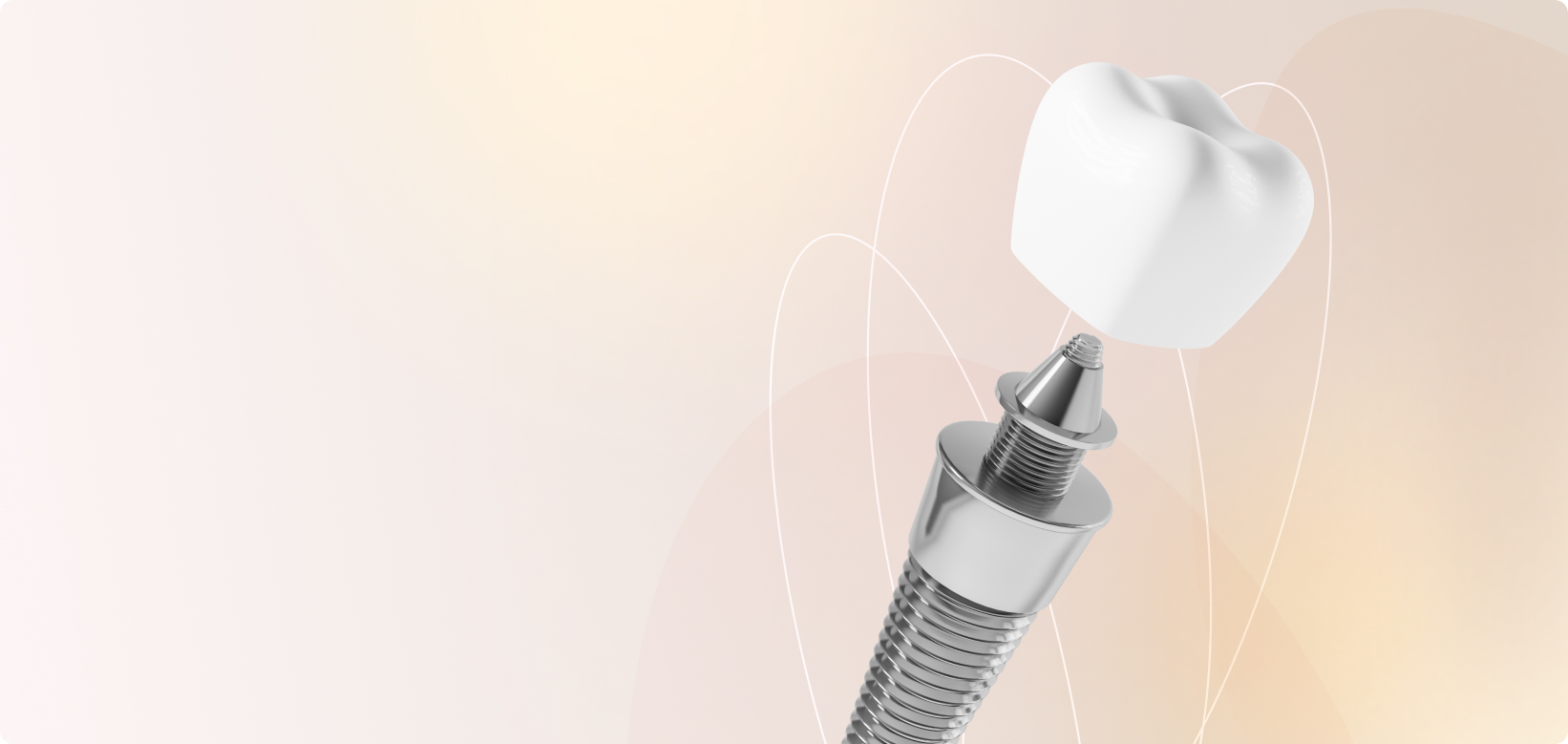 Протез по технологии <nobr>All-on-4</nobr>