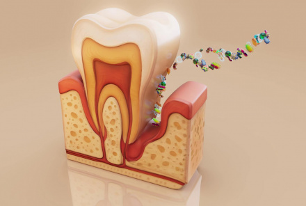 Острый периодонтит